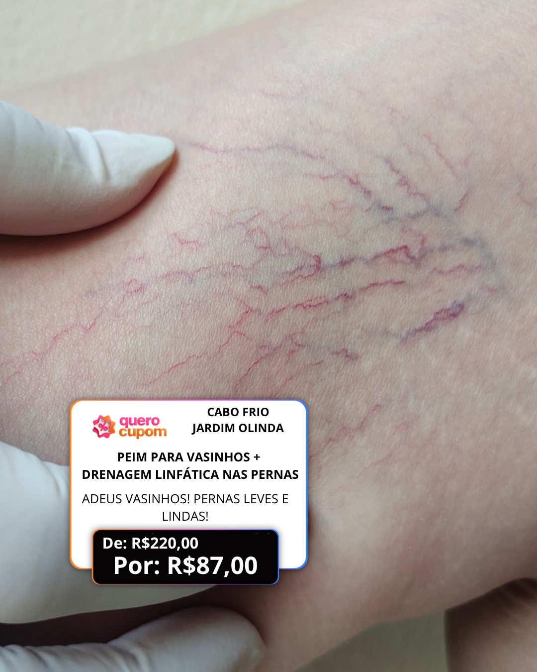 💉 ADEUS VASINHOS! PERNAS LEVES E LINDAS! 💫