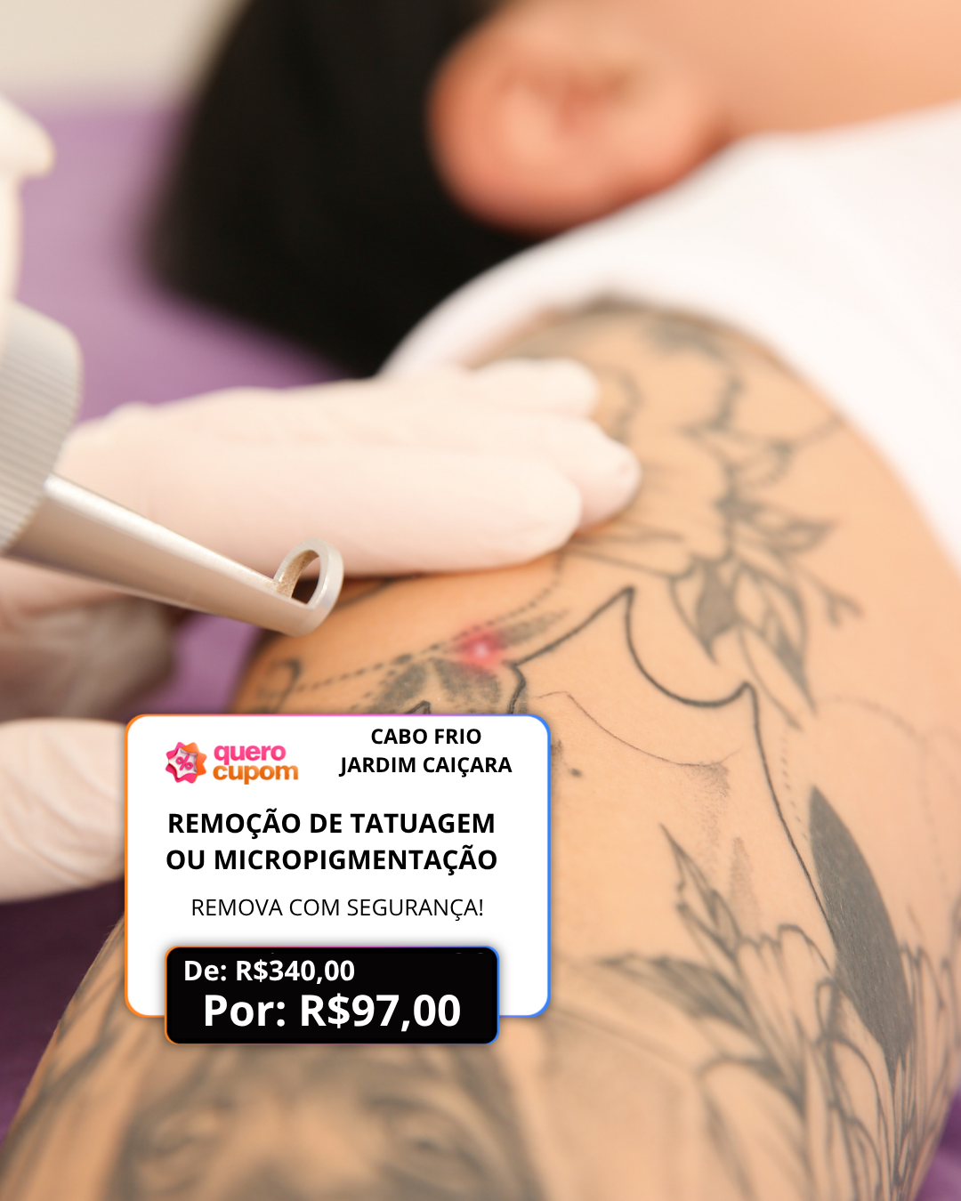 ✨ REMOVA SUA TATUAGEM OU MICROPIGMENTAÇÃO COM SEGURANÇA! ✨