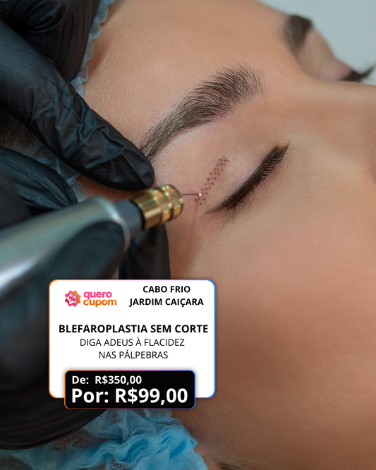 BLEFAROPLASTIA SEM CORTE – DIGA ADEUS À FLACIDEZ NAS PÁLPEBRAS POR APENAS R$ 99! 👁✨